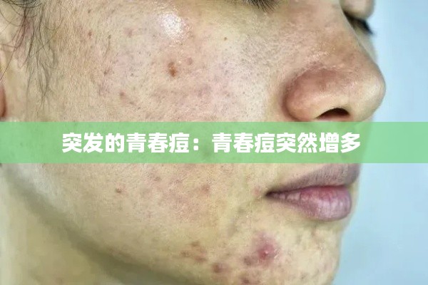 突发的青春痘：青春痘突然增多 