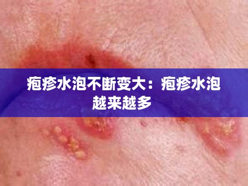 疱疹水泡不断变大：疱疹水泡越来越多 
