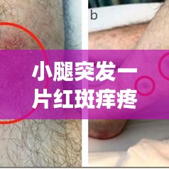 小腿突发一片红斑痒疼：小腿长红斑又痛又痒 