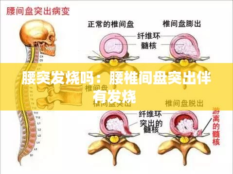 腰突发烧吗：腰椎间盘突出伴有发烧 