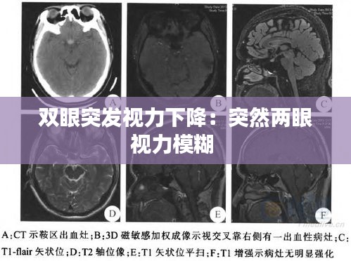 双眼突发视力下降：突然两眼视力模糊 