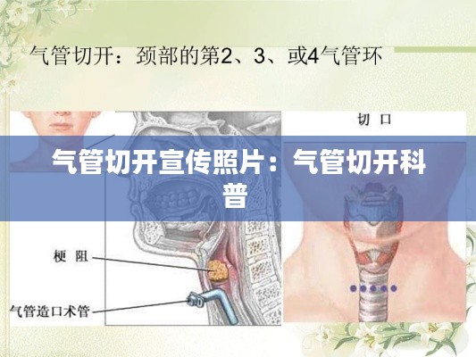 气管切开宣传照片：气管切开科普 