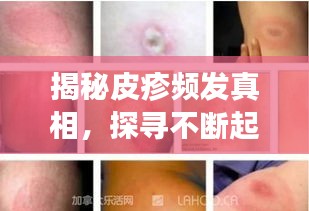 揭秘皮疹频发真相，探寻不断起疹的背后原因