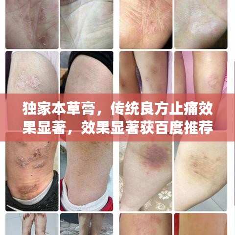 独家本草膏，传统良方止痛效果显著，效果显著获百度推荐